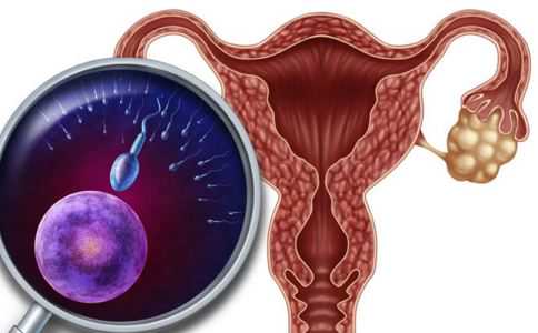 女性多囊卵巢综合征能不能做试管婴儿吗?