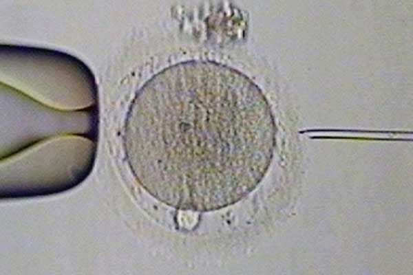 试管y染色体异常_双角子宫怀孕_美国试管婴儿：哪个年龄段的人群需进行基因检