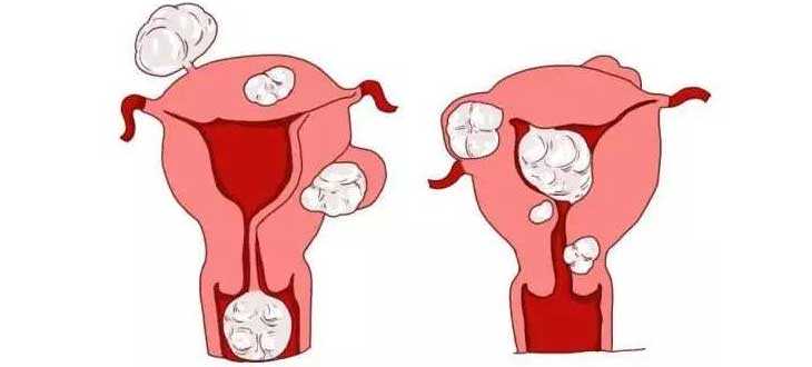试管多次失败_子宫切除能试管吗_去年中已经做了一次宫腔镜检查，输卵管一边